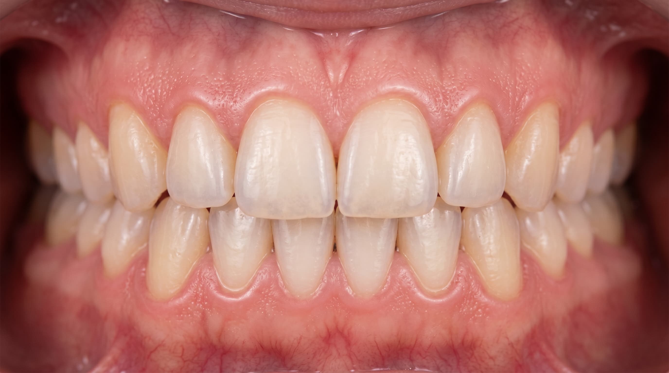 Gum Grafting Procedure: Cost, Recovery, and What to Expect