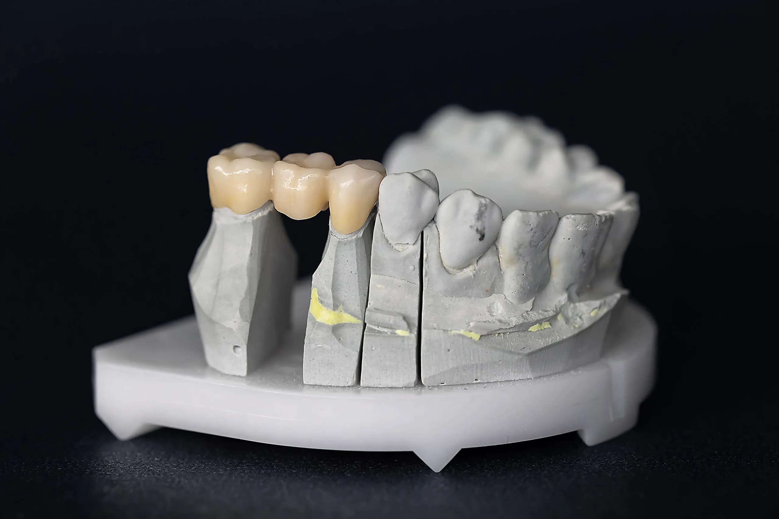 Dental Bridges